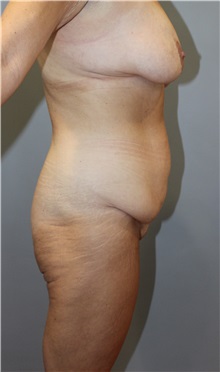 Tummy Tuck Before Photo by Ellen Mahony, MD; Westport, CT - Case 49920 Tummy Tuck Before Photo by Ellen Mahony, MD; Westport, CT - Case 49920