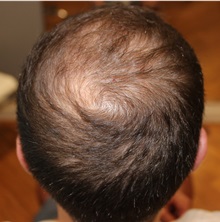 Hair Transplant After Photo by Ellen Mahony, MD; Westport, CT - Case 49939