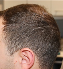 Hair Transplant After Photo by Ellen Mahony, MD; Westport, CT - Case 49939