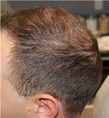 Hair Transplant Before Photo by Ellen Mahony, MD; Westport, CT - Case 49939