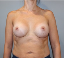 Breast Augmentation After Photo by Ellen Mahony, MD; Westport, CT - Case 49941 Breast Augmentation After Photo by Ellen Mahony, MD; Westport, CT - Case 49941
