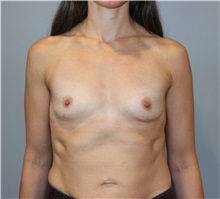 Breast Augmentation Before Photo by Ellen Mahony, MD; Westport, CT - Case 49941 Breast Augmentation Before Photo by Ellen Mahony, MD; Westport, CT - Case 49941