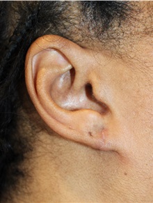 Ear Surgery After Photo by Ellen Mahony, MD; Westport, CT - Case 49944