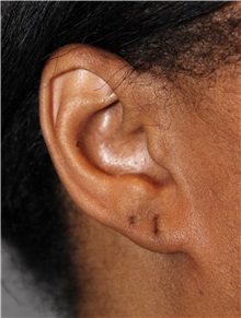 Ear Surgery Before Photo by Ellen Mahony, MD; Westport, CT - Case 49944