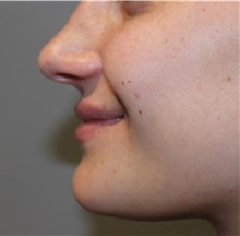 Dermal Fillers After Photo by Ellen Mahony, MD; Westport, CT - Case 50024