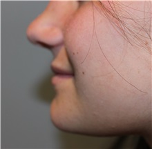 Dermal Fillers Before Photo by Ellen Mahony, MD; Westport, CT - Case 50024