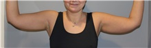 Liposuction Before Photo by Ellen Mahony, MD; Westport, CT - Case 50023