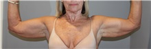 Arm Lift Before Photo by Ellen Mahony, MD; Westport, CT - Case 50022