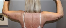 Arm Lift After Photo by Ellen Mahony, MD; Westport, CT - Case 50022