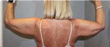Arm Lift Before Photo by Ellen Mahony, MD; Westport, CT - Case 50022