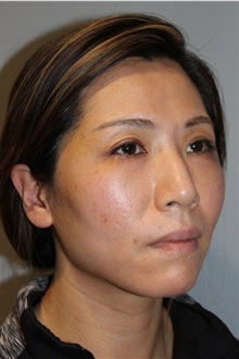 Injectable Fillers and Fat Transfer to the Face After Photo by Ellen Mahony, MD; Westport, CT - Case 50026