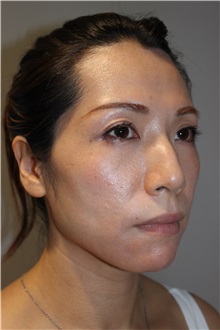Injectable Fillers and Fat Transfer to the Face Before Photo by Ellen Mahony, MD; Westport, CT - Case 50026