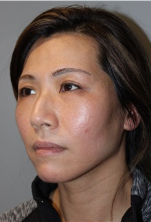 Injectable Fillers and Fat Transfer to the Face After Photo by Ellen Mahony, MD; Westport, CT - Case 50026