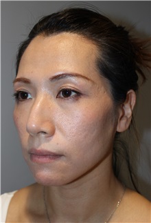 Injectable Fillers and Fat Transfer to the Face Before Photo by Ellen Mahony, MD; Westport, CT - Case 50026