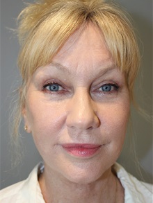 Eyelid Surgery After Photo by Ellen Mahony, MD; Westport, CT - Case 50085 Eyelid Surgery After Photo by Ellen Mahony, MD; Westport, CT - Case 50085