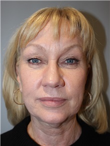 Eyelid Surgery Before Photo by Ellen Mahony, MD; Westport, CT - Case 50085 Eyelid Surgery Before Photo by Ellen Mahony, MD; Westport, CT - Case 50085