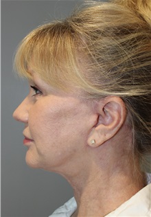 Eyelid Surgery After Photo by Ellen Mahony, MD; Westport, CT - Case 50085