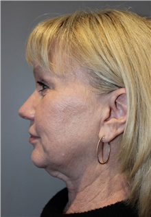 Eyelid Surgery Before Photo by Ellen Mahony, MD; Westport, CT - Case 50085