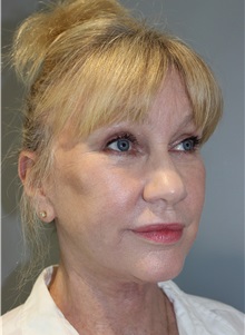 Eyelid Surgery After Photo by Ellen Mahony, MD; Westport, CT - Case 50085