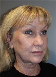 Eyelid Surgery Before Photo by Ellen Mahony, MD; Westport, CT - Case 50085