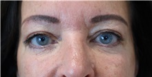 Eyelid Surgery After Photo by Ellen Mahony, MD; Westport, CT - Case 50084
