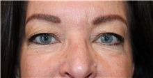 Eyelid Surgery Before Photo by Ellen Mahony, MD; Westport, CT - Case 50084