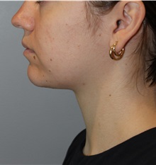 Liposuction After Photo by Ellen Mahony, MD; Westport, CT - Case 50086 Liposuction After Photo by Ellen Mahony, MD; Westport, CT - Case 50086