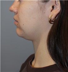 Liposuction Before Photo by Ellen Mahony, MD; Westport, CT - Case 50086 Liposuction Before Photo by Ellen Mahony, MD; Westport, CT - Case 50086