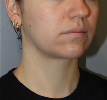 Liposuction After Photo by Ellen Mahony, MD; Westport, CT - Case 50086