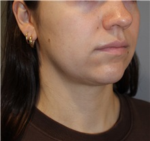 Liposuction Before Photo by Ellen Mahony, MD; Westport, CT - Case 50086