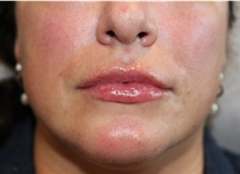 Dermal Fillers After Photo by Ellen Mahony, MD; Westport, CT - Case 50089 Dermal Fillers After Photo by Ellen Mahony, MD; Westport, CT - Case 50089