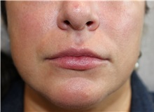 Dermal Fillers Before Photo by Ellen Mahony, MD; Westport, CT - Case 50089 Dermal Fillers Before Photo by Ellen Mahony, MD; Westport, CT - Case 50089