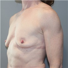 Breast Reconstruction Before Photo by Ellen Mahony, MD; Westport, CT - Case 50155