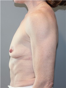 Breast Reconstruction Before Photo by Ellen Mahony, MD; Westport, CT - Case 50155