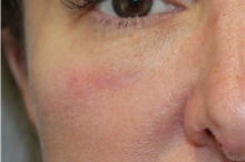 Microsurgery After Photo by Ellen Mahony, MD; Westport, CT - Case 50152