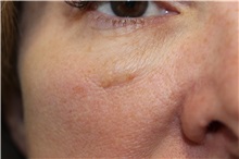 Microsurgery Before Photo by Ellen Mahony, MD; Westport, CT - Case 50152