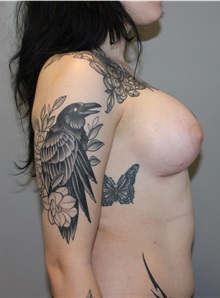 Breast Augmentation After Photo by Ellen Mahony, MD; Westport, CT - Case 50156