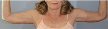 Arm Lift After Photo by Ellen Mahony, MD; ,  - Case 50226