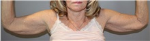Arm Lift Before Photo by Ellen Mahony, MD; ,  - Case 50226