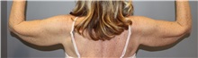 Arm Lift Before Photo by Ellen Mahony, MD; ,  - Case 50226