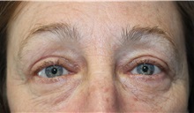 Eyelid Surgery After Photo by Ellen Mahony, MD; Westport, CT - Case 50227