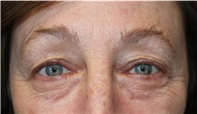 Eyelid Surgery Before Photo by Ellen Mahony, MD; Westport, CT - Case 50227