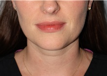 Nonsurgical Fat Reduction After Photo by Ellen Mahony, MD; Westport, CT - Case 50229