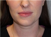 Nonsurgical Fat Reduction Before Photo by Ellen Mahony, MD; Westport, CT - Case 50229