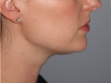 Nonsurgical Fat Reduction After Photo by Ellen Mahony, MD; Westport, CT - Case 50229