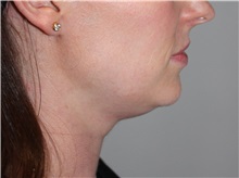 Nonsurgical Fat Reduction Before Photo by Ellen Mahony, MD; Westport, CT - Case 50229