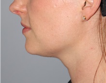 Nonsurgical Fat Reduction After Photo by Ellen Mahony, MD; Westport, CT - Case 50229