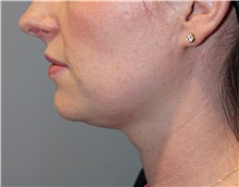Nonsurgical Fat Reduction Before Photo by Ellen Mahony, MD; Westport, CT - Case 50229