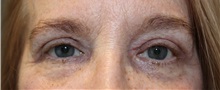Eyelid Surgery After Photo by Ellen Mahony, MD; Westport, CT - Case 50230