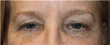 Eyelid Surgery Before Photo by Ellen Mahony, MD; Westport, CT - Case 50230